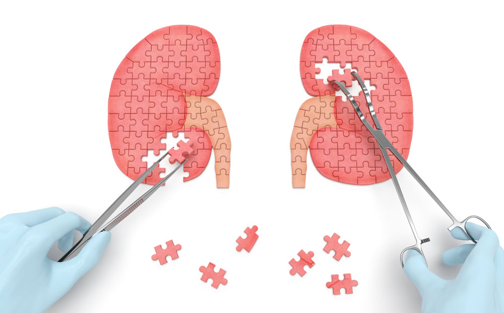 Saiba tudo sobre cálculo renal
